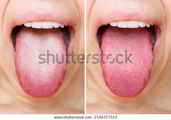 Female tongue with a\
white plaque. Comparison of a diseased tongue with a white plaque\
and a healthy clean tongue before and after treatment. The result\
of cleaning the tongue