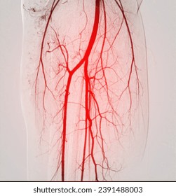 A Femoral Angiogram is a medical procedure used to visualize blood vessels in the groin area.