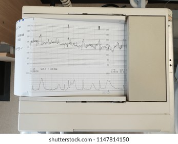 A Fetal Heart Rate Monitor Printing The Results Of A Live Monitoring Session Of A Woman Not In Labour