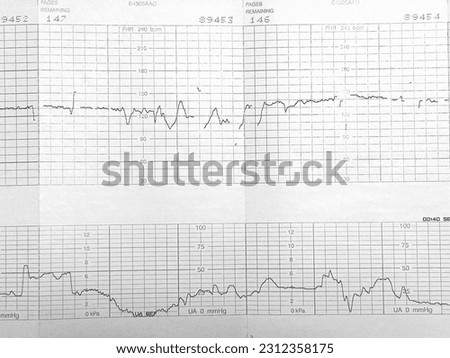 Fetal Heart Rate Monitoring Strip