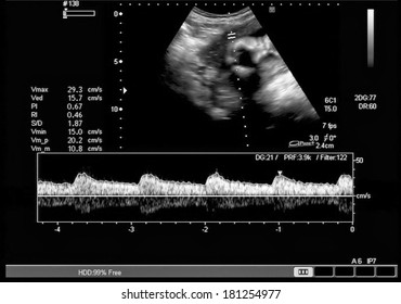 Fetal Heartbeat.