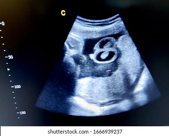 Fetal Hydrocele Testis By Ultrasound