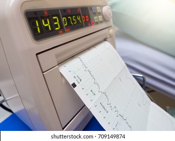 Fetal Monitor Or Non Stress Test Printing The Baby's Heart Beats Or Electrocardiograph And Mother Uterine Contraction During Delivery Or Birth In Delivery Or Labor Room At Hospital