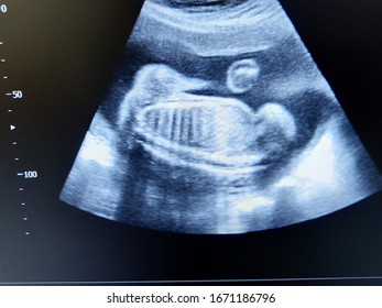 fetal spine and ribs by ultrasound scan - Shutterstock ID 1671186796