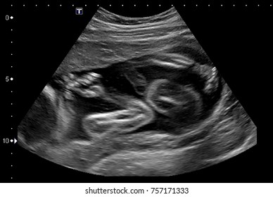 Fetal Ultrasound Exam