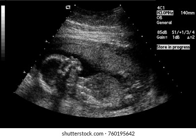 Fetal Ultrasound Image