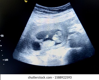 fetus 11 weeks by ultrasound scan - Shutterstock ID 1588922593