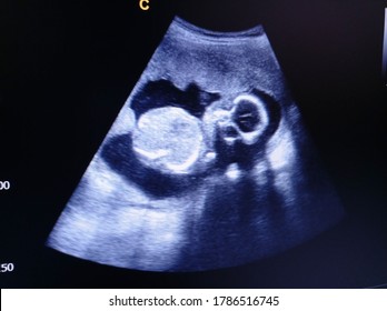 Fetus 19 Weeks By Ultrasound