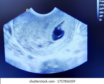 349 Amniotic Sac Images, Stock Photos & Vectors | Shutterstock