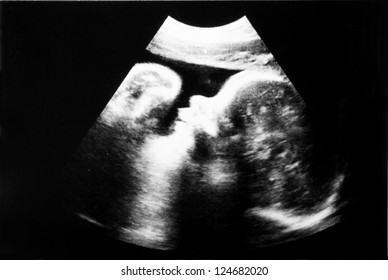 Fetus 7 month in the womb. Visible head and arms - Powered by Shutterstock