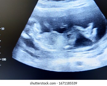 fetus legs by ultrasound scan - Shutterstock ID 1671185539