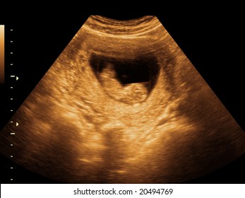 Fetus Sonogram Stock Photo Edit Now