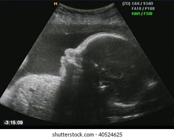 Fetus ultrasound at 27 weeks