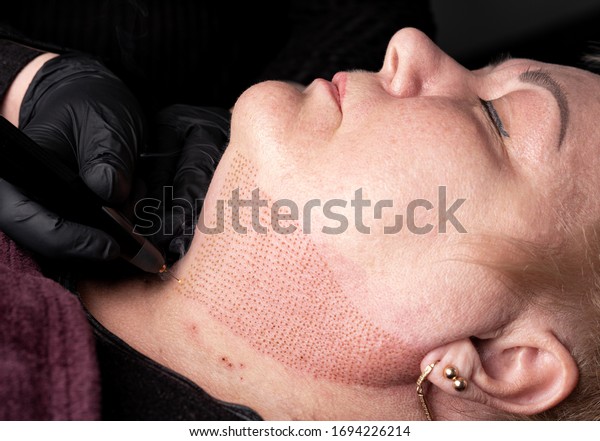 Fibroblast, plasmalifting procedure womens neck\
wrinkles lifting