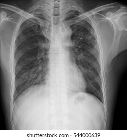 92 Lung apex Images, Stock Photos & Vectors | Shutterstock