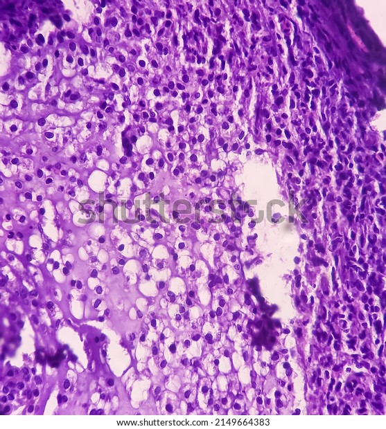 fibroepithelialis papilloma