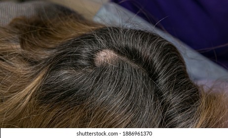 Fibroma and atheroma on the head of a person before surgery - Shutterstock ID 1886961370