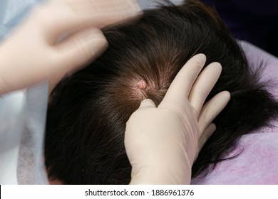 Fibroma And Atheroma On The Head Of A Person Before Surgery