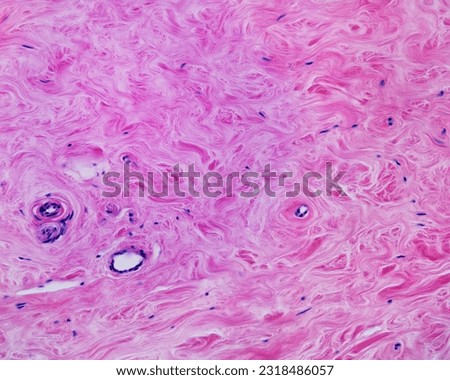 Fibrous or dense connective tissue with densely packed collagen fibers, forming intertwined fascicles. Among fibers, there are fibroblasts and small blood vessels.