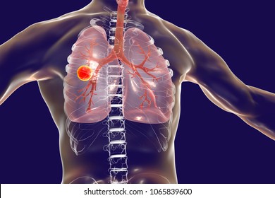 Fibrous-cavernous pulmonary tuberculosis, 3D illustration showing tuberculosis cavity in the lung