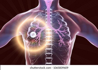Fibrous-cavernous pulmonary tuberculosis, 3D illustration showing tuberculosis cavity in the lung