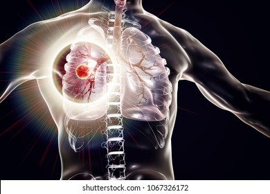 Fibrous-cavernous pulmonary tuberculosis, 3D illustration showing tuberculosis cavity in the lung