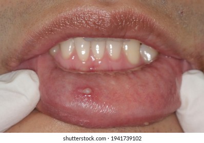 human papillomavirus warts in mouth
