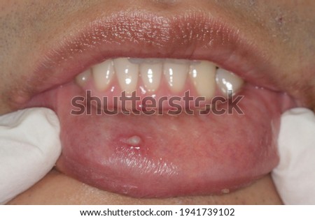 Filiform warts on lower lips are caused by human papillomavirus (HPV), which is a viral infection that’s spread through skin-to-skin contact.