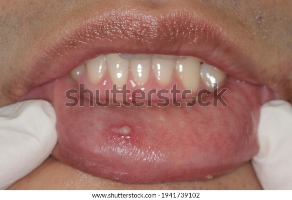 Filiform warts on lower lips are caused by human\
papillomavirus (HPV), which is a viral infection that’s spread\
through skin-to-skin\
contact.