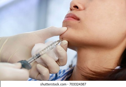 Filler Injection Chin Make Chin Longer 