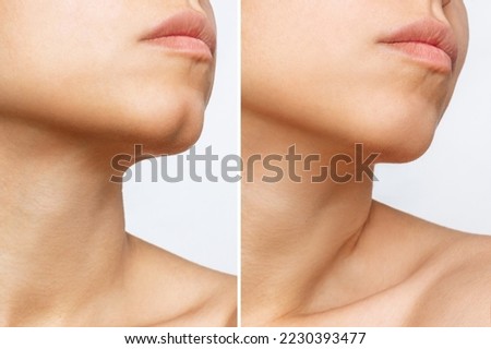 Filling the dimple on the chin with fillers. Woman's face with jaws and chin before and after dimplectomy isolated on a white background. The result of cosmetic plastic surgery. Beauty concept