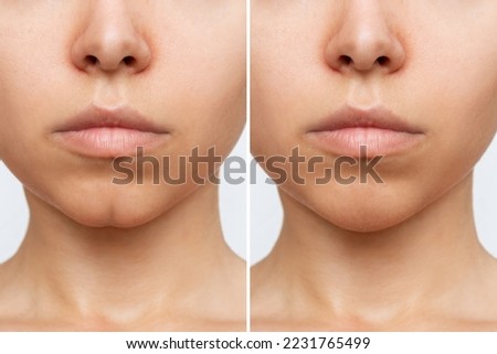 Filling the dimple on the chin with fillers. Woman's face with jaws and chin before and after dimplectomy on a white background. The result of cosmetic plastic surgery. Beauty concept. Comparison