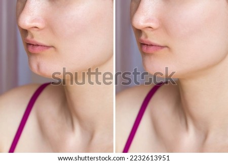Filling the dimple on the chin with fillers. Woman's face with jaws and chin before and after dimplectomy. The result of cosmetic plastic surgery. Beauty concept. Comparison