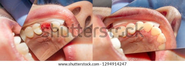 filling and restoration of tooth loss with\
adhesive composite material close-up. Concept before and after\
dentistry treatment