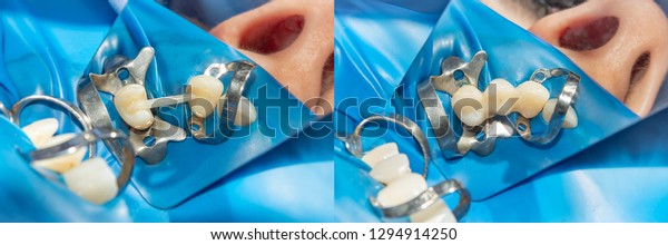filling and restoration of tooth loss with\
adhesive composite material close-up. Concept before and after\
dentistry treatment