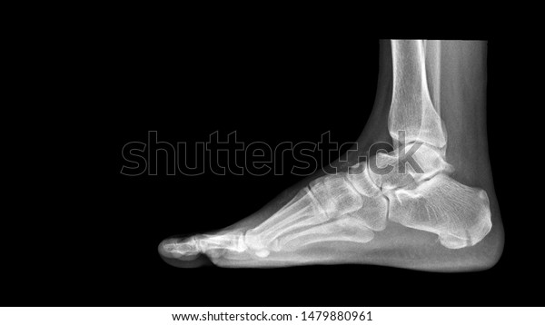 Film ankle X ray radiograph showing heel bone broken\
(Calcaneus fracture) from fall from height. The patient had heel\
pain, swelling and could not walk. Medical imaging concept \
