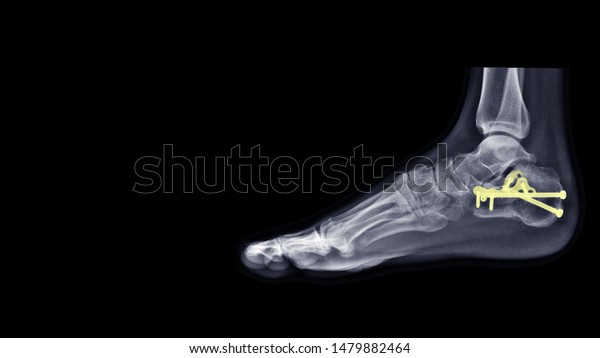 Film Ankle Xray Radiograph Show Heel Stock Photo (Edit Now) 1479882464
