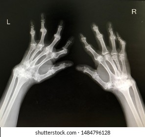 Film Both Hand Of Rheumatoid Arthritis Patient