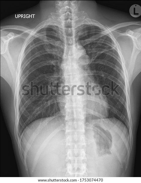 Film Chest Xray Ap Upright Stock Photo (Edit Now) 1753074470