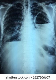 Xray Image Human Chest Medical Diagnosis Stock Photo (Edit Now) 215460532