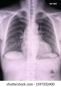 Chest Xray Pa Upright Position Normal Stock Photo (Edit Now) 1577118409