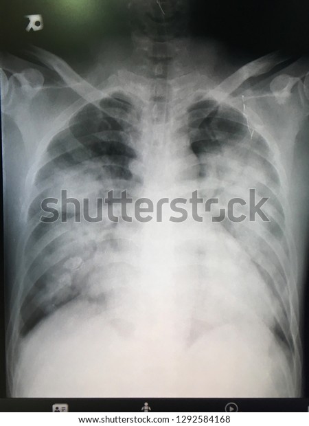 520 Acute Chest Syndrome Images, Stock Photos & Vectors | Shutterstock