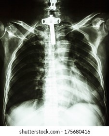 Film Chest X-ray PA Upright : Show Human Chest With Tracheotomy Tube