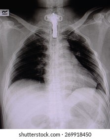 Film Chest X-ray PA Upright : Show Human Chest With Tracheotomy Tube