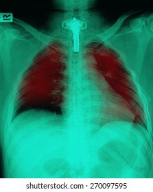 Film Chest X-ray PA Upright : Show Human Chest With Tracheotomy Tube