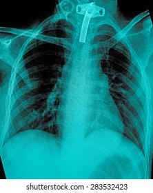 Film Chest X-ray PA Upright : Show Human Chest With Tracheotomy Tube