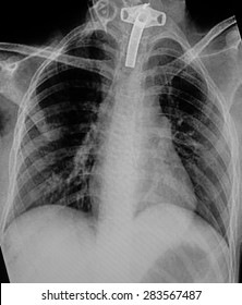 Film Chest X-ray PA Upright : Show Human Chest With Tracheotomy Tube