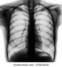 Film Chest Xray Pa Upright Show Stock Photo 670614418 | Shutterstock