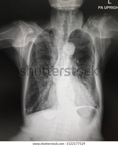 Film Chest Xray Pa Upright Copd Stock Photo (Edit Now) 1522177529