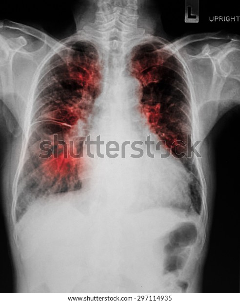 Film Chest Xray Show Alveolar Infiltrate Stock Photo (Edit Now) 297114935